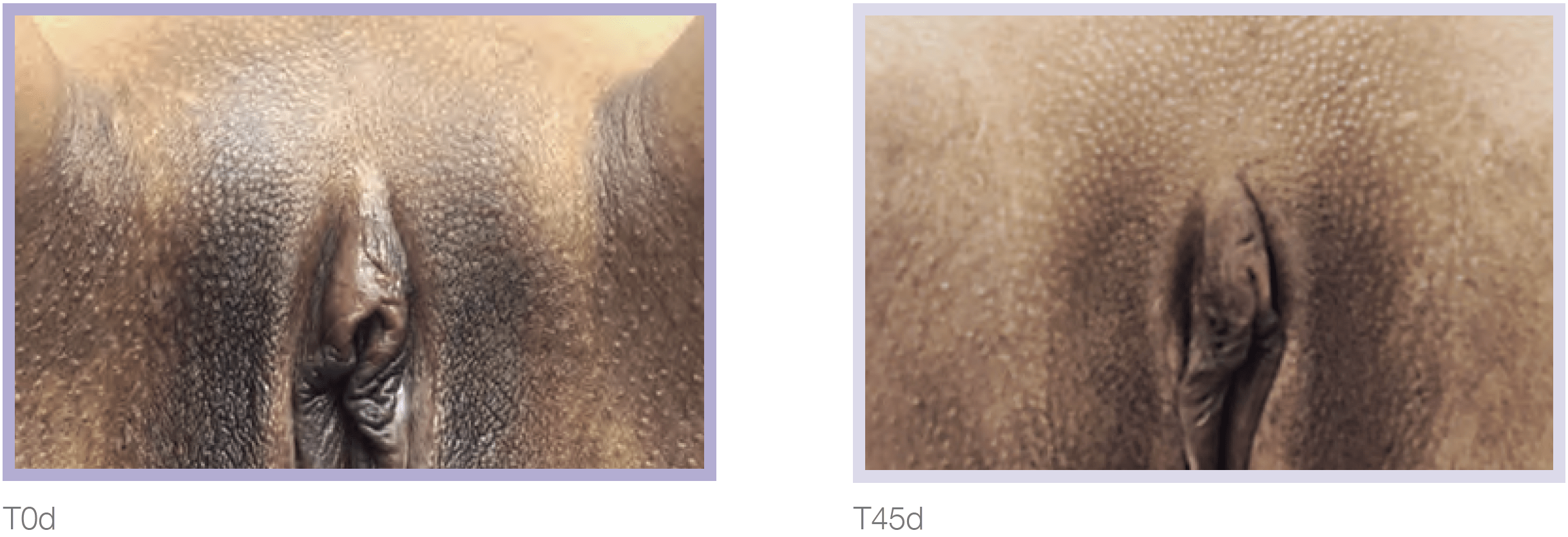 Dermamelan Intimate Before & After in Pikesville & Baltimore 00001