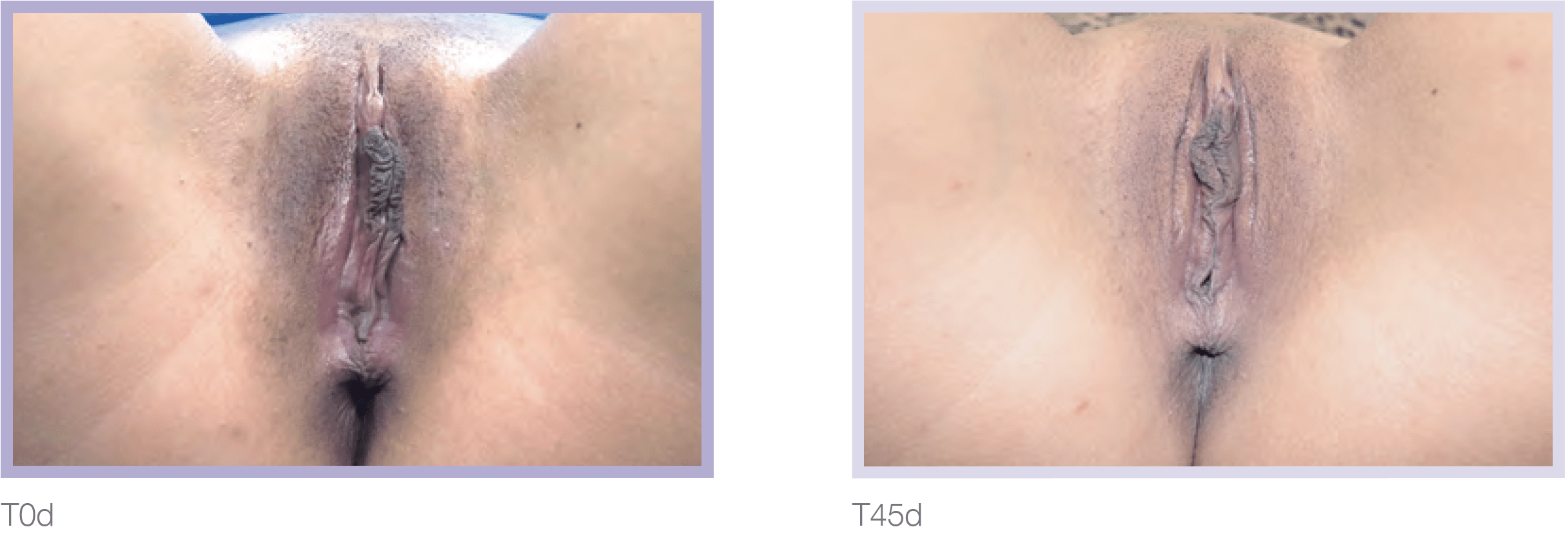 Dermamelan Intimate Before & After in Pikesville & Baltimore 00003