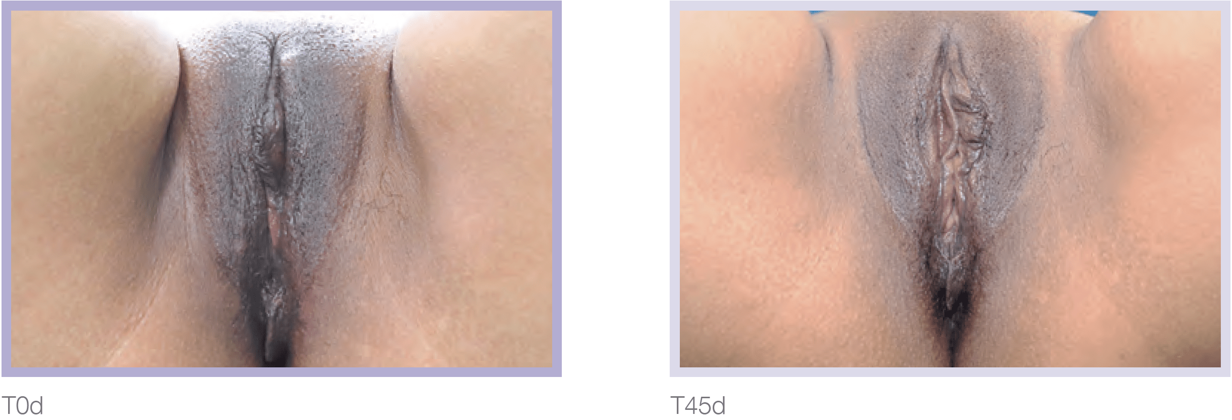 Dermamelan Intimate Before & After in Pikesville & Baltimore 00004