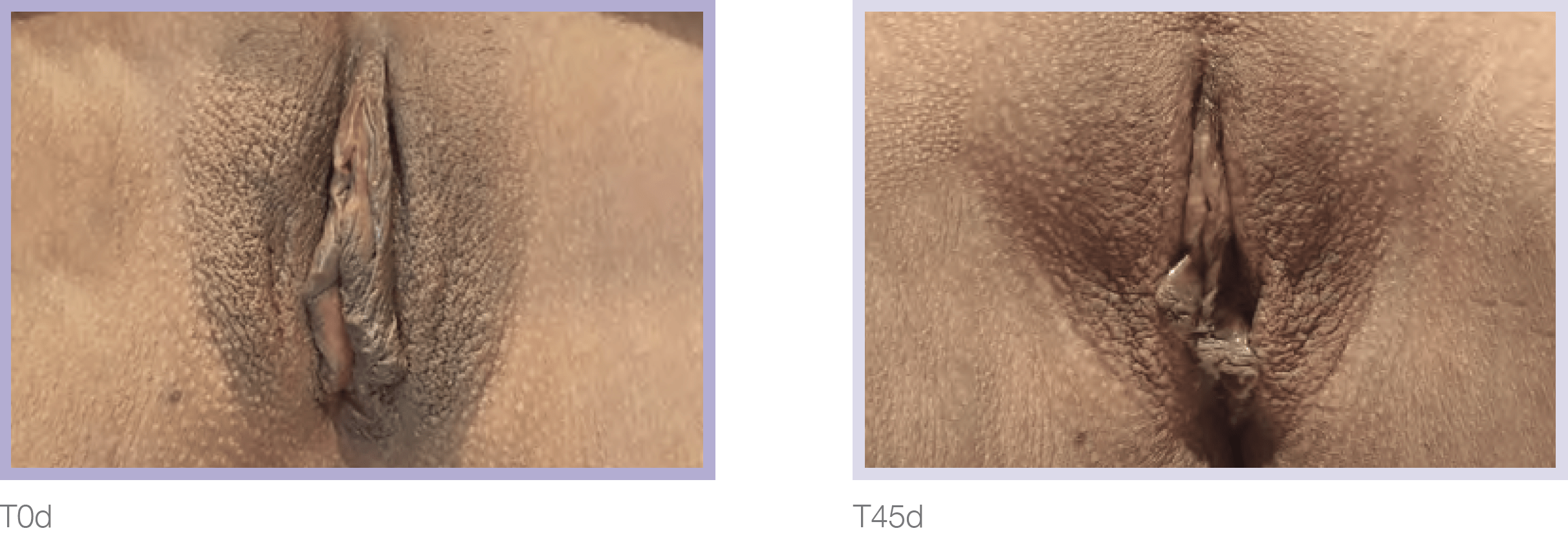 Dermamelan Intimate Before & After in Pikesville & Baltimore 00005