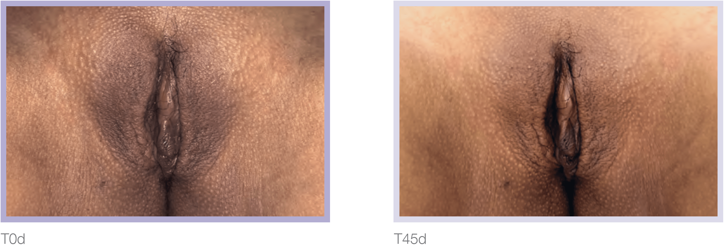 Dermamelan Intimate Before & After in Pikesville & Baltimore 00006