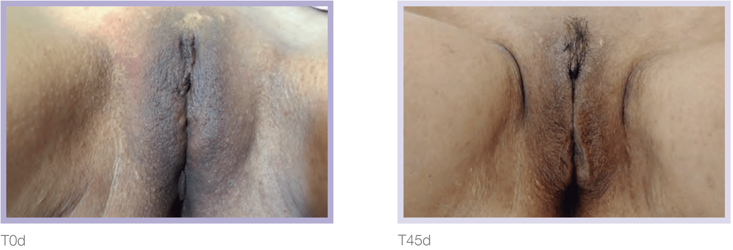 Dermamelan Intimate Before & After in Pikesville & Baltimore 00007