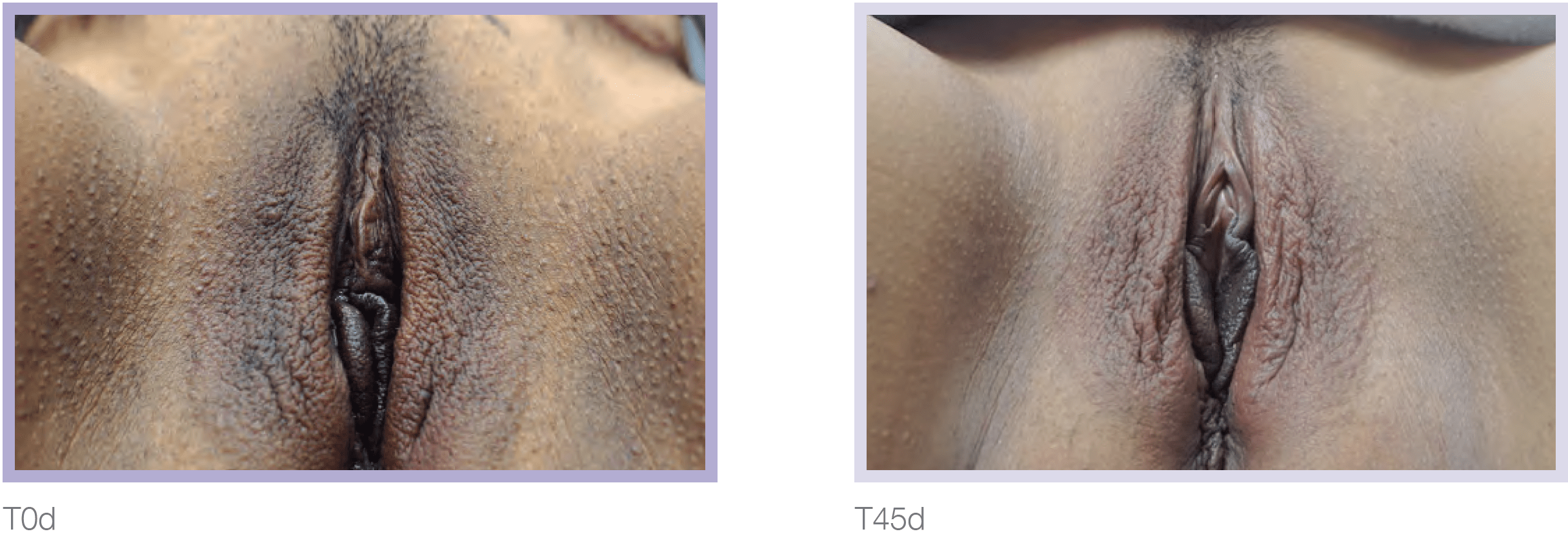 Dermamelan Intimate Before & After in Pikesville & Baltimore 00008