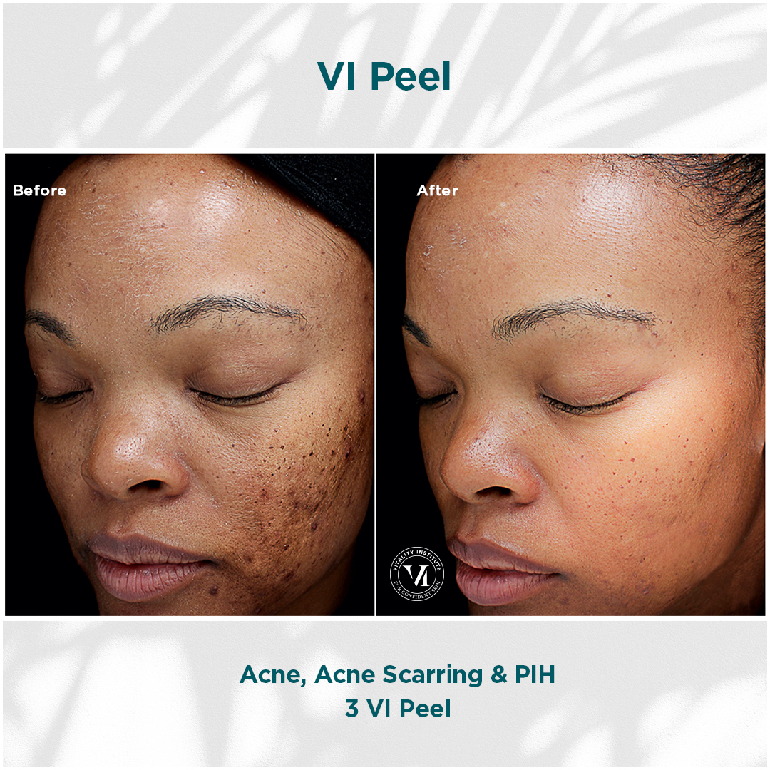 Vi Peel Treatment Before & After In Pikesville and Baltimore Maryland 00001