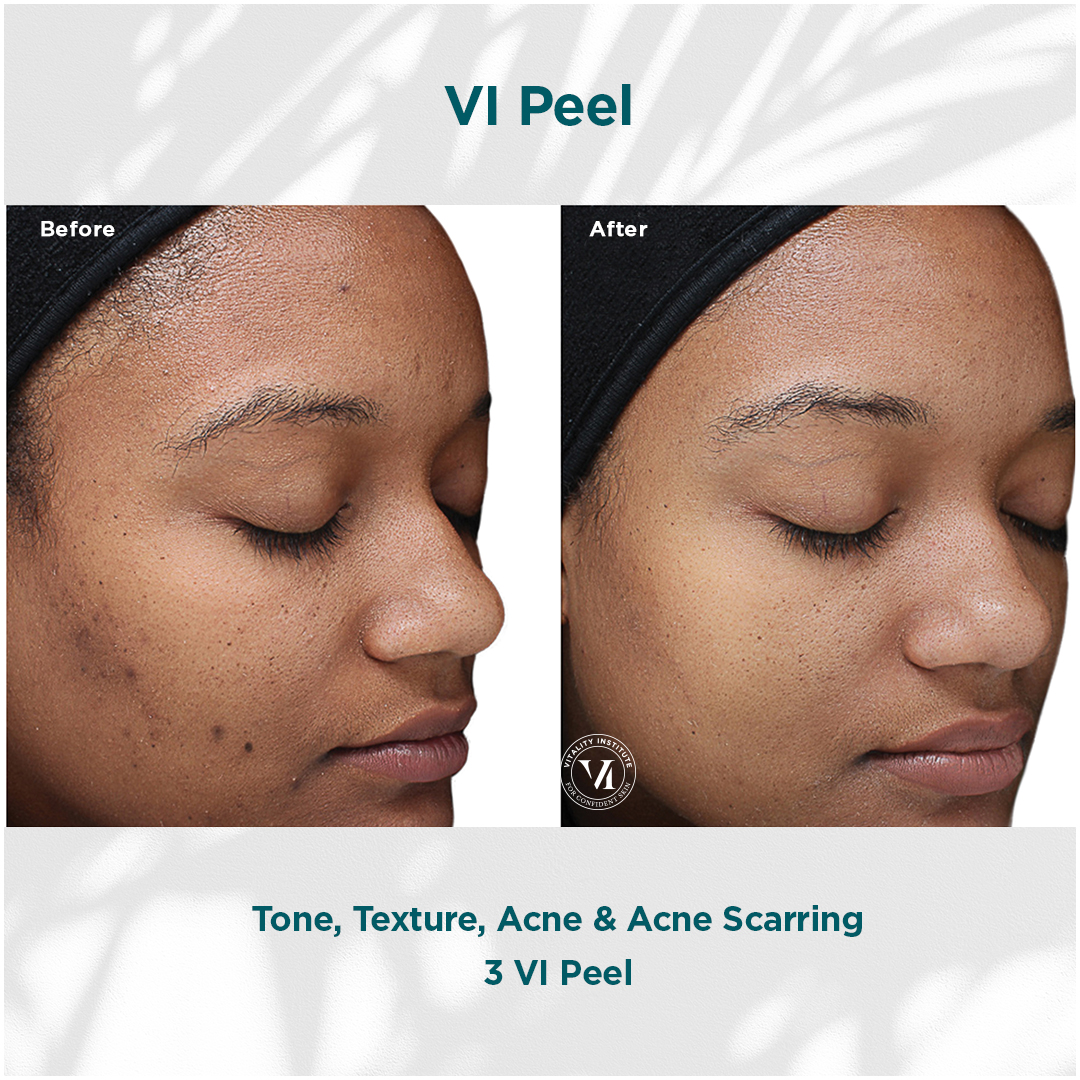 Vi Peel Treatment Before & After In Pikesville and Baltimore Maryland 00002