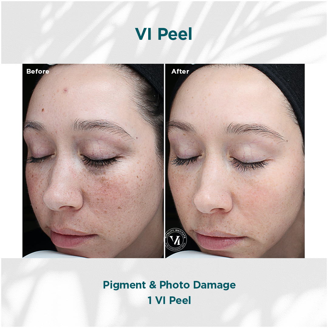 Vi Peel Treatment Before & After In Pikesville and Baltimore Maryland 00003
