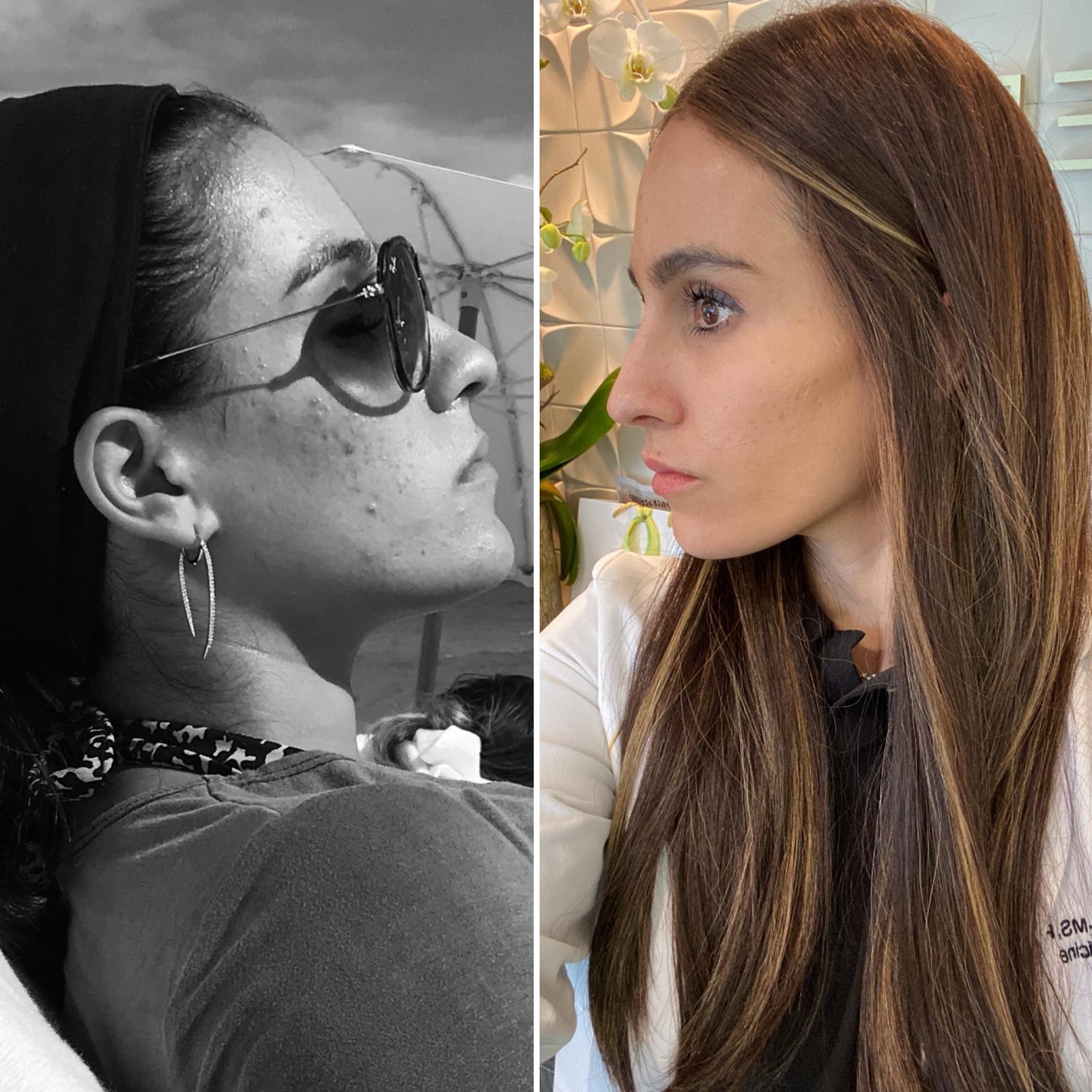 Acne-Scar-Removal-in-Baltimore-MD