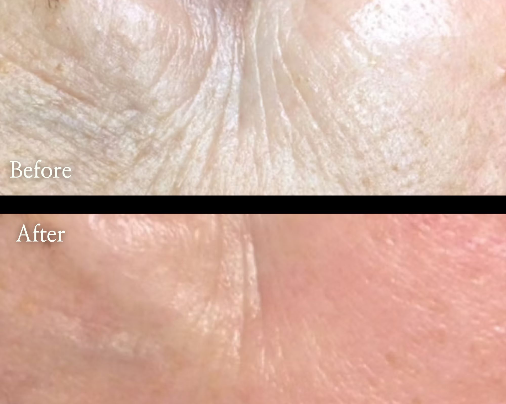 Microneedling-in-Baltimore-MD