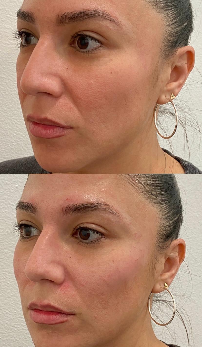 Cheeks-Before-After-Treatment-in-Baltimore-MD