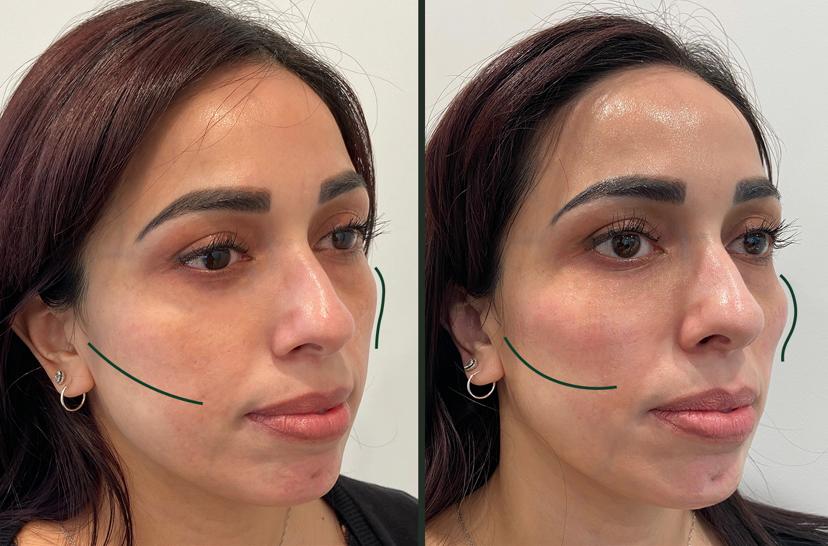 Cheeks-Before-After2-Treatment-in-Baltimore-MD