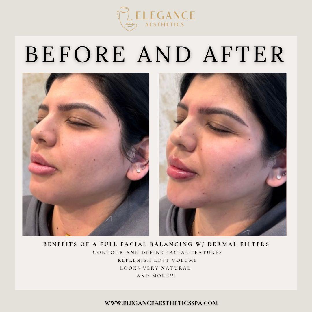 Facial-Balancing-Before-After-Treatment-in-Baltimore-MD
