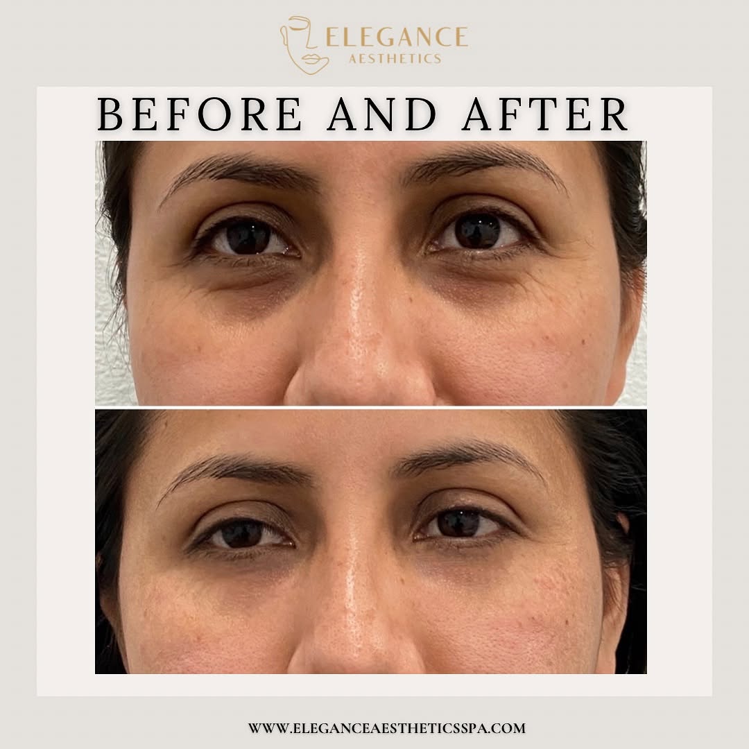 Under-Eye-Filler-in-Baltimore-MD