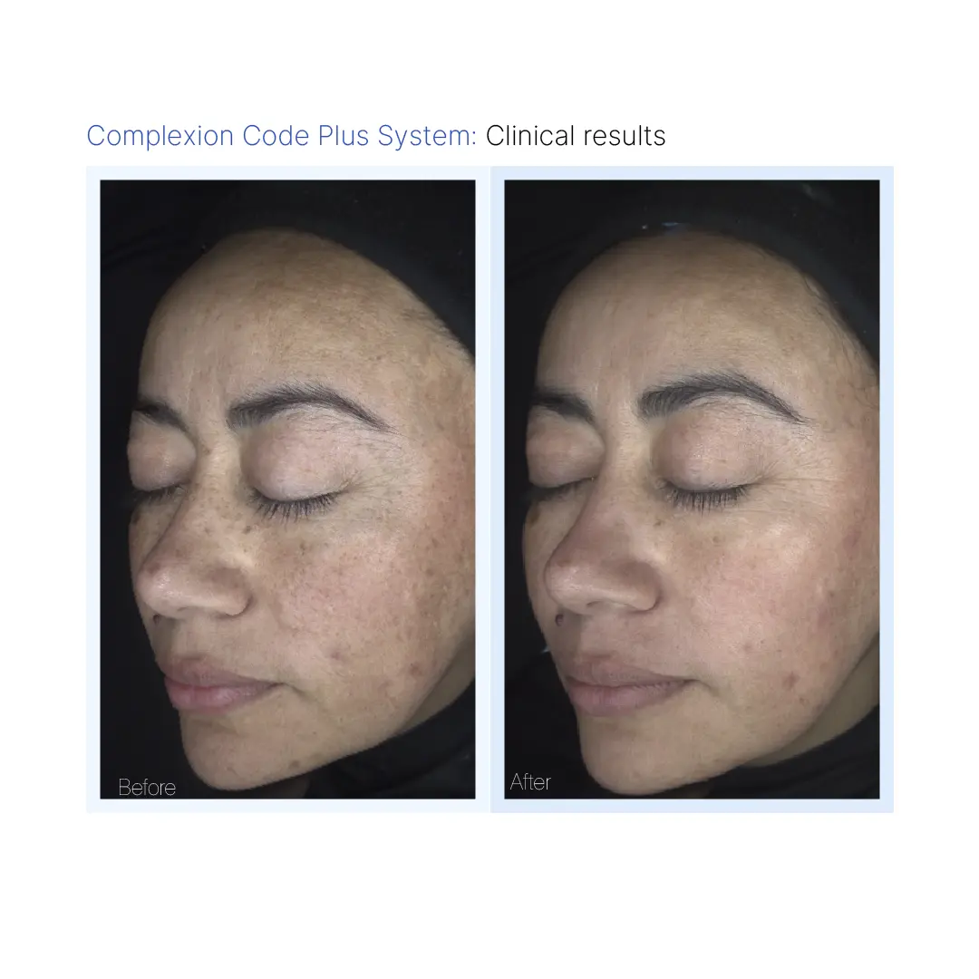 Complexion Code Plus Before & After Pikesville & Baltimore 00001
